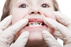 Nguyên nhân nào khiến trẻ bị sâu răng? Cách ngừa sâu răng hiệu quả cho bé