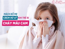 Chảy máu cam là gì? Cách xử lý trẻ khi bị chảy máu cam