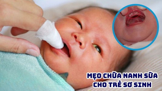 Mẹo chữa nanh sữa cho trẻ sơ sinh hiệu quả, an toàn