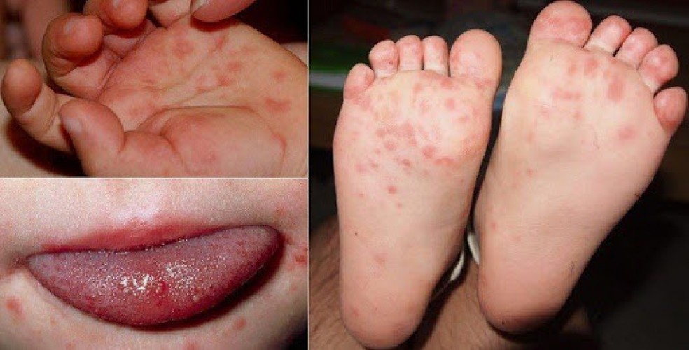 Bệnh tay chân miệng ở trẻ em: Nguyên nhân, dấu hiệu và cách chữa