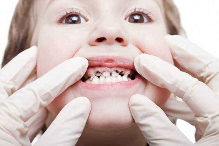 Nguyên nhân nào khiến trẻ bị sâu răng? Cách ngừa sâu răng hiệu quả cho bé