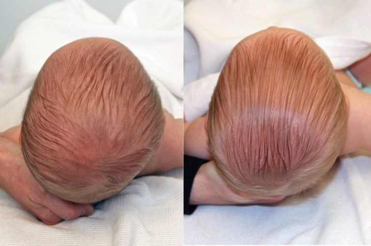 Trẻ sơ sinh bị bẹp đầu có sao không? Mẹo hay chữa bẹp đầu cho trẻ