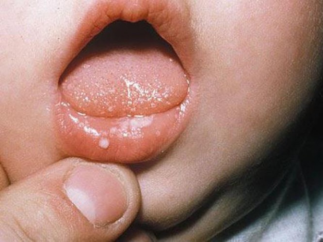 Cách chữa nhiệt miệng ở trẻ sơ sinh an toàn, hiệu quả