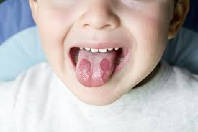 Trẻ em bị rộp lưỡi phải làm sao? Nguyên nhân và cách xử lý hiệu quả