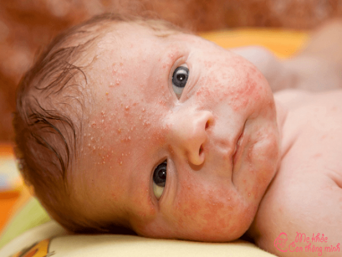 Nguyên nhân và cách xử lý trẻ sơ sinh nổi mẩn đỏ trên mặt