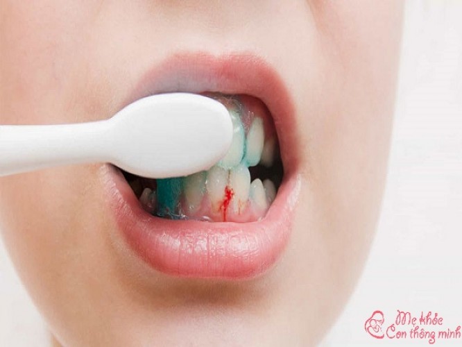 Chảy máu chân răng là bệnh gì? Có nguy hiểm không?