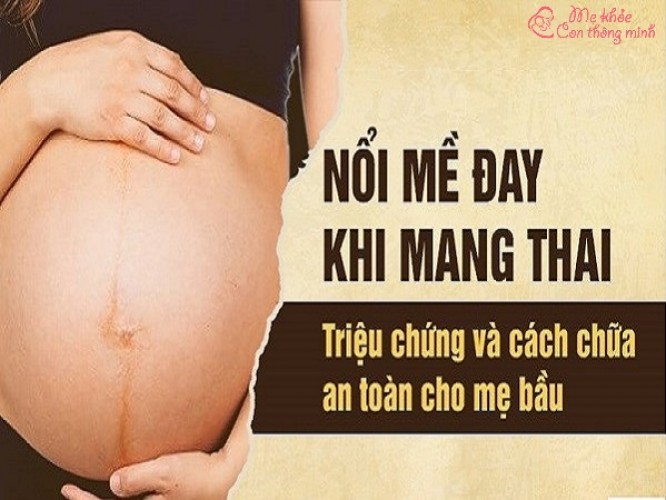 Những điều bạn nên biết về bệnh nổi mề đay khi mang thai