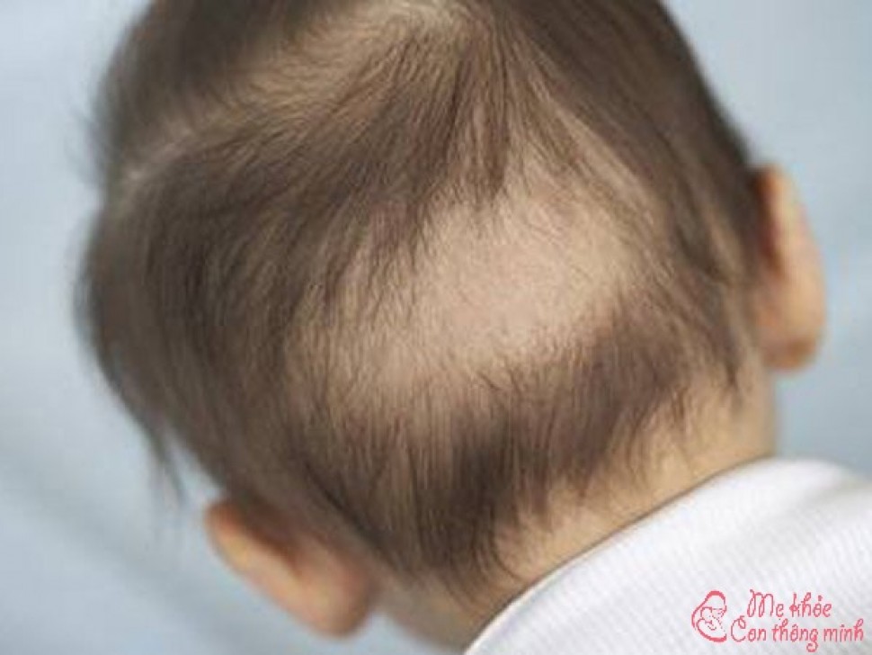 Lộ diện phương pháp khắc phục tình trạng rụng tóc vành khăn tốt nhất ở trẻ