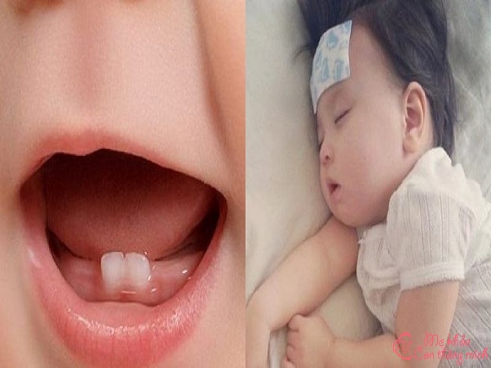 Top 5 điều ba mẹ cần lưu ý khi trẻ sốt mọc răng