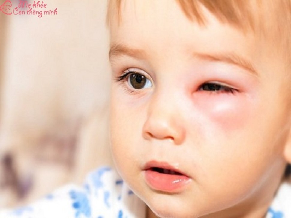 Nguyên nhân và cách điều trị bệnh viêm bờ mi mắt ở trẻ nhỏ