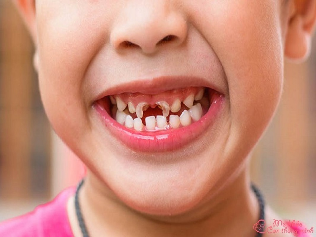 Cách chữa sâu răng cho trẻ 2 tuổi, áp dụng 1 lần là khỏi luôn