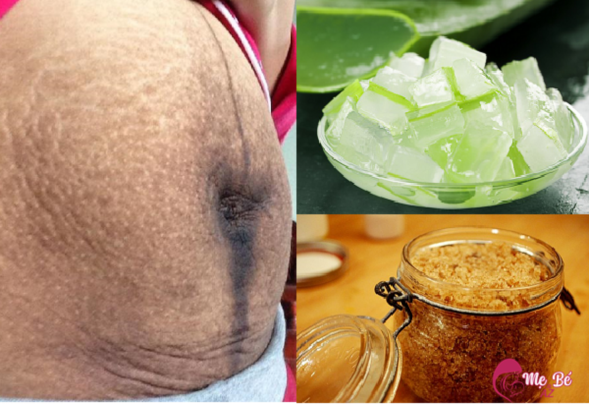 Top 5 cách trị thâm bụng sau sinh hiệu quả nhất hiện nay