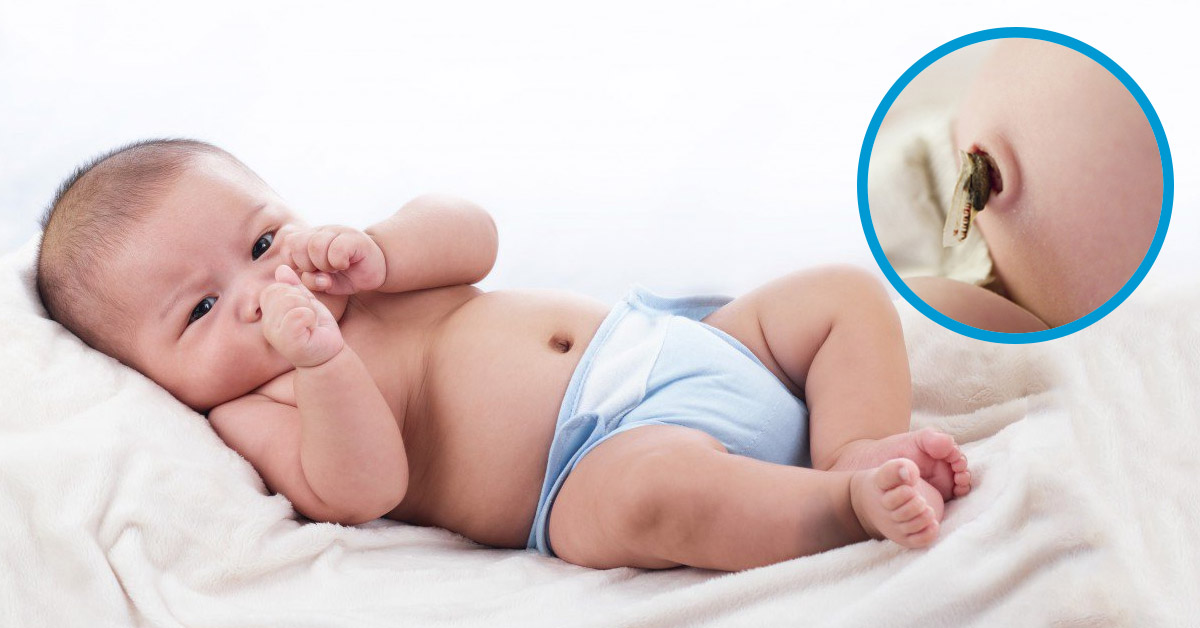 Cách Chăm Sóc Rốn Cho Trẻ Sơ Sinh Đúng Cách Tại Nhà, Tránh Nhiễm Trùng