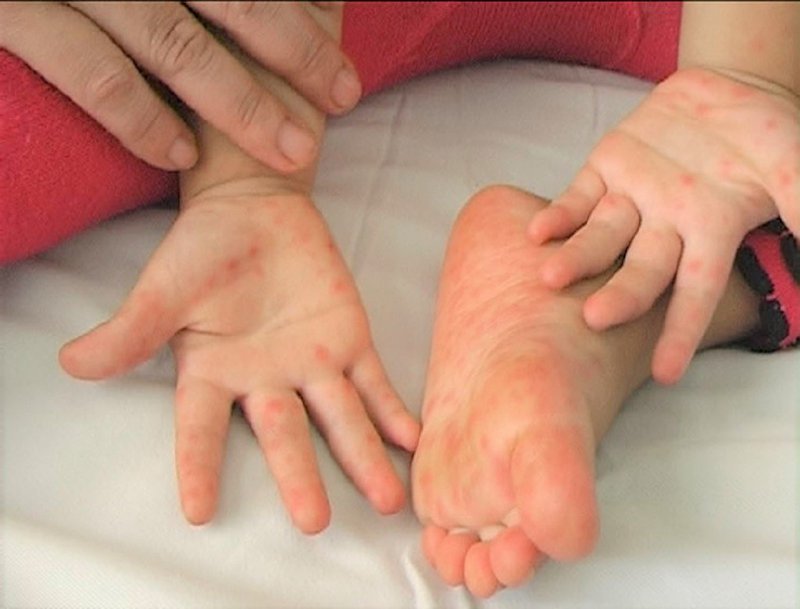 hình ảnh bệnh tay chân miệng ở trẻ em, nguyên nhân bệnh tay chân miệng, dấu hiệu khỏi bệnh tay chân miệng, cách chữa bệnh chân tay miệng, dấu hiệu bệnh tay chân miệng, bệnh tay chân miệng cấp độ 1, bệnh tay chân miệng ở trẻ em, bệnh tay chân miệng ở trẻ nhỏ, bệnh tay chân miệng ở trẻ sơ sinh, bệnh tay chân miệng ở trẻ