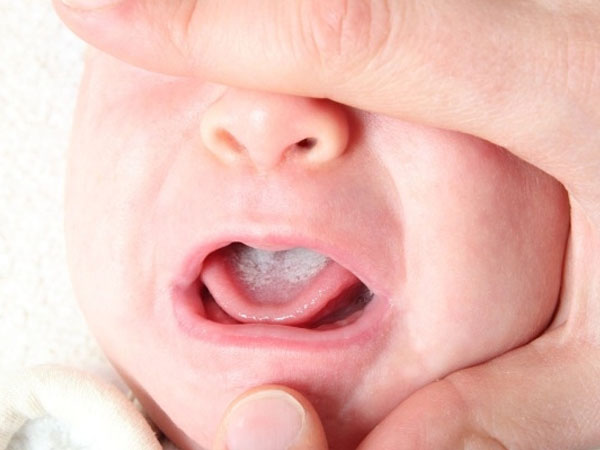 nhiệt miệng ở trẻ sơ sinh, cách trị nhiệt miệng ở trẻ sơ sinh, chữa nhiệt miệng ở trẻ sơ sinh, trị nhiệt miệng ở trẻ sơ sinh, cách chữa nhiệt miệng ở trẻ sơ sinh, cách điều trị nhiệt miệng ở trẻ sơ sinh, bị nhiệt miệng ở trẻ sơ sinh, bệnh nhiệt miệng ở trẻ sơ sinh, hình ảnh nhiệt miệng ở trẻ sơ sinh, dấu hiệu nhiệt miệng ở trẻ sơ sinh, biểu hiện nhiệt miệng ở trẻ sơ sinh, chữa bệnh nhiệt miệng ở trẻ sơ sinh, dấu hiệu bị nhiệt miệng ở trẻ sơ sinh, triệu chứng nhiệt miệng ở trẻ sơ sinh, mẹo chữa nhiệt miệng ở trẻ sơ sinh, hiện tượng nhiệt miệng ở trẻ sơ sinh
