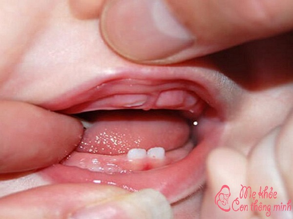 thứ tự mọc răng của trẻ nhỏ, thứ tự mọc răng của trẻ sơ sinh, thứ tự mọc răng của trẻ con, thứ tự mọc răng của em bé
