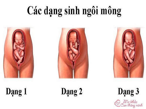 ngôi thai ngược có nguy hiểm không, ngôi thai ngược, ngôi thai ngược nên mổ ở tuần bao nhiều, thai ngược có nguy hiểm không, ngôi thai ngược là gì, ngôi thai ngược có đẻ thường được không, ngôi thai ngược có sinh thường được không, ngôi thai ngược có sao không, cách khắc phục ngôi thai ngược, ngôi thai ngược phải làm sao, ngôi thai ngược là như thế nào
