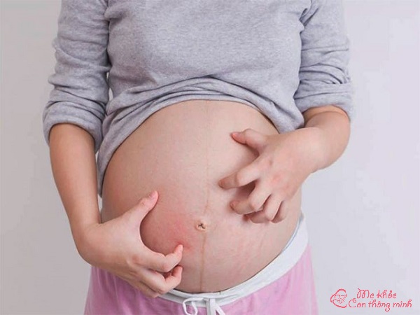 nổi mề đay khi mang thai, bầu bị nổi mề đay, nổi mề đay khi mang thai 3 tháng đầu, mề đay khi mang thai, mẹ bầu bị nổi mề đay, nổi mề đay khi mang thai tháng cuối, bị nổi mề đay khi mang thai, cách chữa nổi mề đay khi mang thai