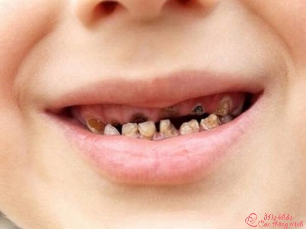 sún răng, trẻ bị sún răng, bé sún răng, em bé sún răng, bé bị sún răng, trẻ em bị sún răng sữa, thuốc chữa sún răng cho trẻ, sún răng là gì, sún răng ở trẻ, cách chữa sún răng cho trẻ, răng sún là gì, súng răng, em bé bị sún răng, răng sún ở trẻ em, răng sún, bị sún răng, trẻ sún răng, thuốc trị sún răng cho bé, răng bị sún, thuốc trị sún răng cho bé của nhật, hình ảnh bé bị sún răng, răng sún đen, cách chữa sún răng cho bé, bé bị sún răng phải làm sao, trẻ bị sún răng sữa phải làm sao, sun rang, sún tất, răng trẻ bị đốm đen, cách chữa ăn mòn chân răng cho bé, trẻ bị ăn mòn chân răng, ảnh sún răng