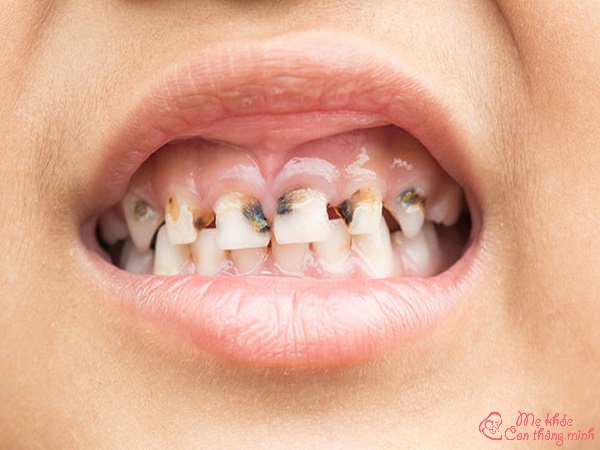 sún răng, trẻ bị sún răng, bé sún răng, em bé sún răng, bé bị sún răng, trẻ em bị sún răng sữa, thuốc chữa sún răng cho trẻ, sún răng là gì, sún răng ở trẻ, cách chữa sún răng cho trẻ, răng sún là gì, súng răng, em bé bị sún răng, răng sún ở trẻ em, răng sún, bị sún răng, trẻ sún răng, thuốc trị sún răng cho bé, răng bị sún, thuốc trị sún răng cho bé của nhật, hình ảnh bé bị sún răng, răng sún đen, cách chữa sún răng cho bé, bé bị sún răng phải làm sao, trẻ bị sún răng sữa phải làm sao, sun rang, sún tất, răng trẻ bị đốm đen, cách chữa ăn mòn chân răng cho bé, trẻ bị ăn mòn chân răng, ảnh sún răng