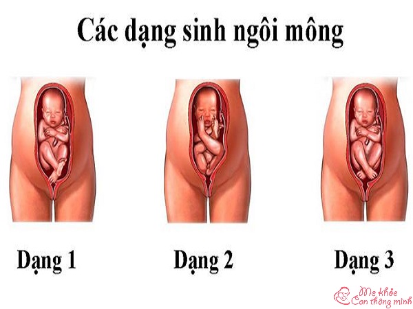 thai ngôi mông, thai ngôi mông nên mổ ở tuần bao nhiều, thai ngôi mông là gì, ngôi thai mông là gì, thai ngôi mông có ảnh hưởng gì không, thai ngôi mông có sinh thường được không, thai ngôi mông là sao, thai nhi ngôi mông là gì, thai ngôi mông có chuyển dạ không, thai ngôi mông có nguy hiểm không
