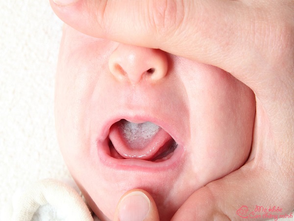 cách trị đẹn cho trẻ sơ sinh, thuốc trị đẹn miệng cho trẻ sơ sinh, cách chữa sài đẹn cho trẻ sơ sinh, cách trị đẹn lưỡi cho trẻ sơ sinh
